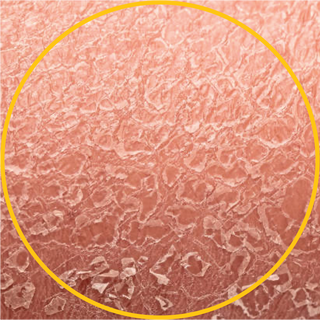 Dry Skin
