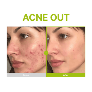 Azelaic Acid 10 Kojic Azulene Serum 30ml